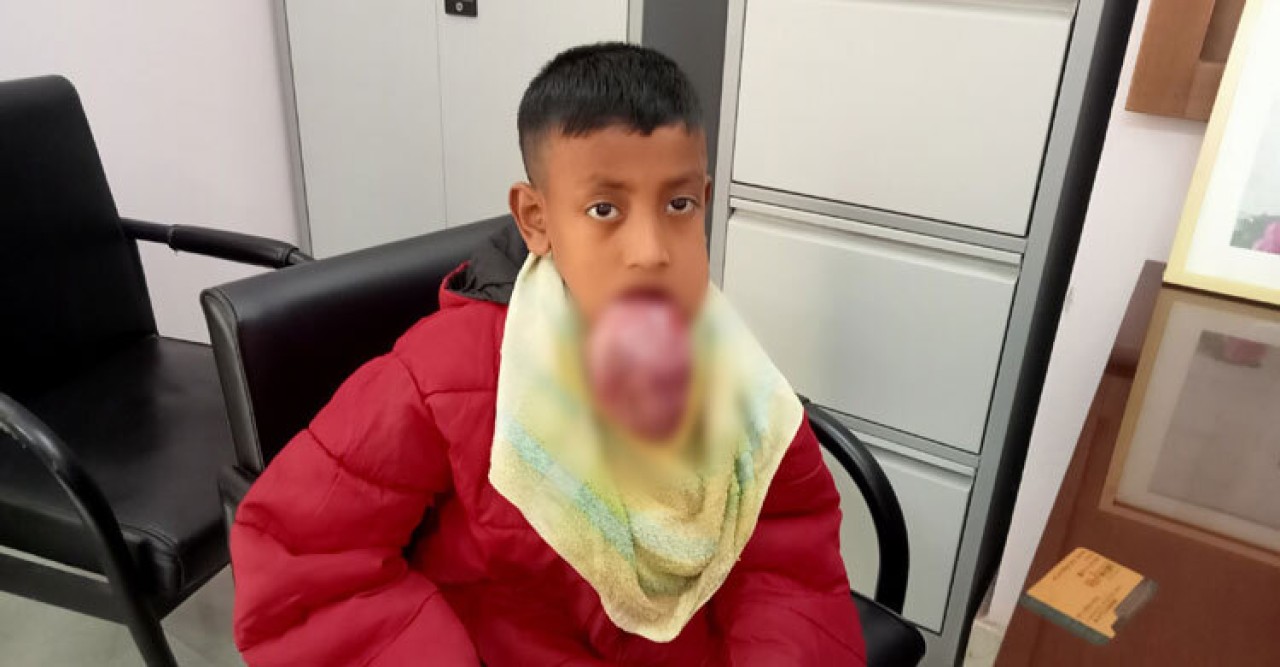জিহ্বার ভার বহন করতে পারছে না জুবায়ের, অর্থের অভাবে চিকিৎসা বন্ধ